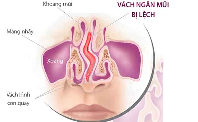 Cách chữa vẹo vách ngăn mũi không cần phẫu thuật