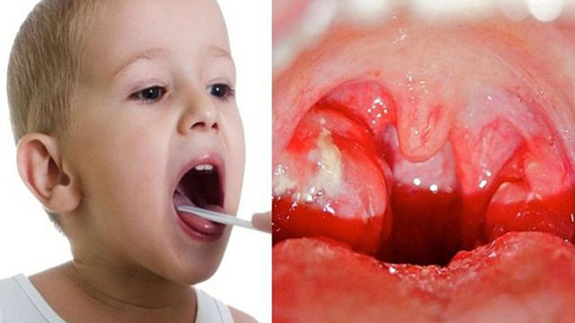 Hình ảnh viêm amidan ở trẻ