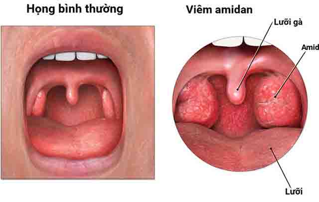 Hình ảnh viêm amidan