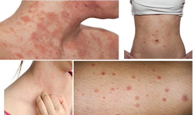Hình ảnh viêm da cơ địa người lớn