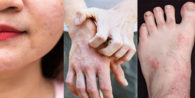 Hình ảnh viêm da cơ địa