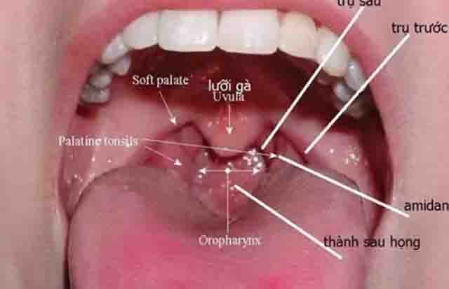 Hình ảnh viêm họng