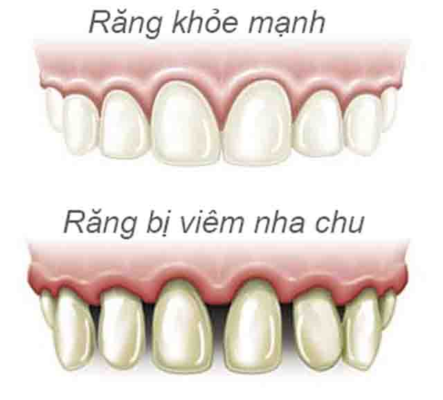 Hình ảnh viêm nướu răng