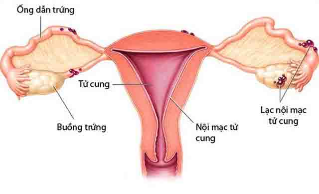 Lạc nội mạc tử cung - Chị em cần biết về lạc nội mạc tử cung, nguyên nhân, triệu chứng