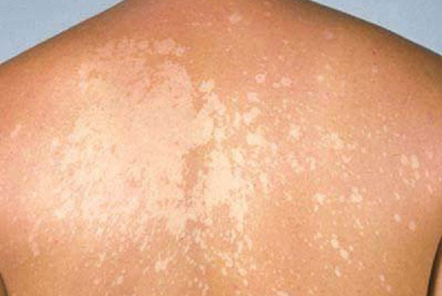 Lang ben - Các yếu tố nguy cơ gây bệnh lang ben, dấu hiệu cách phòng ngừa