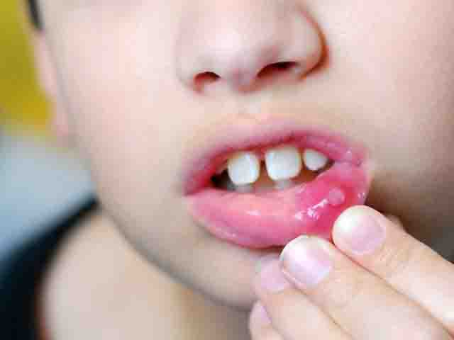 Lở miệng - Một số thực phẩm nên dùng khi lở miệng