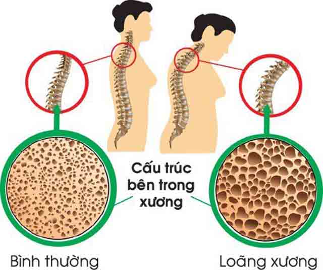 Triệu chứng của bệnh loãng xương