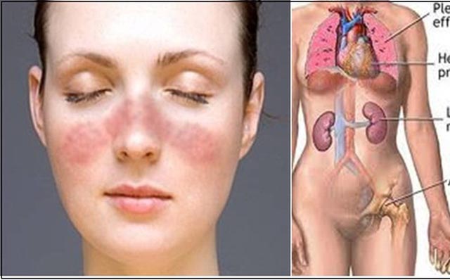 Lupus ban đỏ có chết không