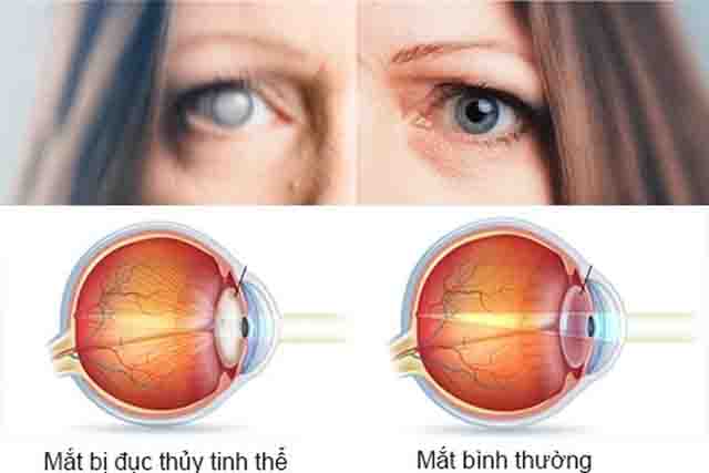 Mổ đục thủy tinh thể mắt sáng trong bao lâu