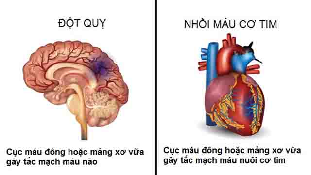 Mỡ máu cao - Nguy cơ tai biến khi tăng mỡ máu, dự phòng
