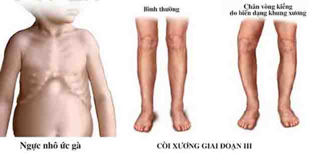 Thiếu vitamin D - Một số bệnh do cơ thể thiếu vitamin D