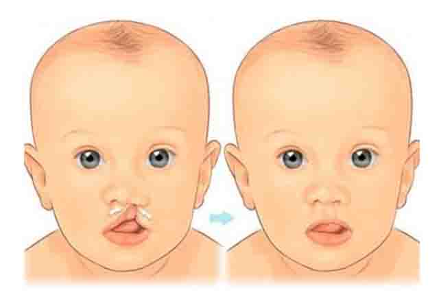 Hở môi - Một số điều cần biết về khe hở môi, nguyên nhân