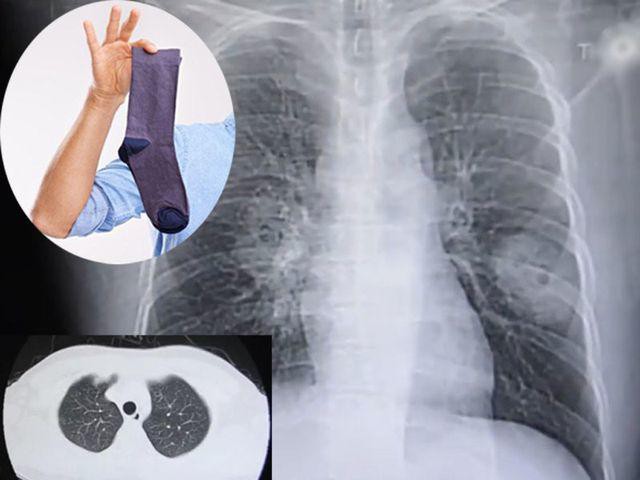 Bệnh nấm phổi có lây không