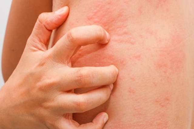 Nguyên nhân nổi mề đay