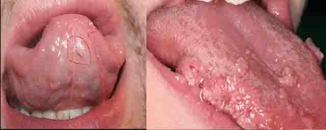 Sùi mào gà - Những triệu chứng bệnh sùi mào gà ở nam giới