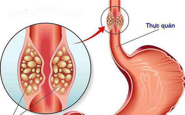 Viêm thực quản - Tìm hiểu bệnh viêm thực quản, nguyên nhân, triệu chứng