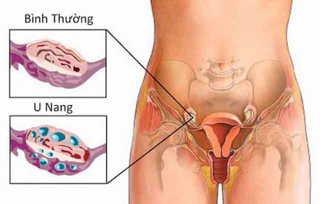 Nguyên nhân u nang buồng trứng