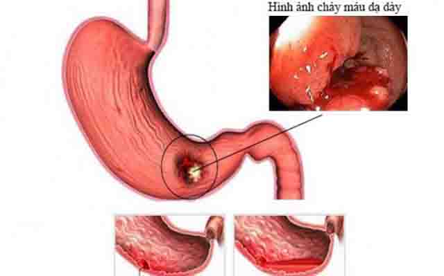Xuất huyết đường tiêu hóa - Tìm hiểu bệnh xuất huyết đường tiêu hóa, nguyên nhân, triệu chứng