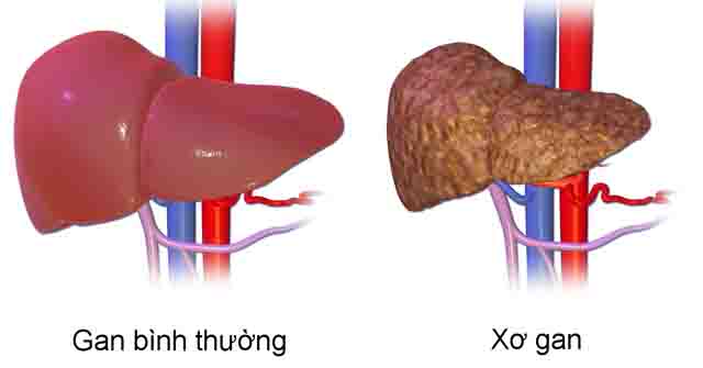 Xơ gan - Cùng tìm hiểu bệnh xơ gan, nguyên nhân, triệu chứng