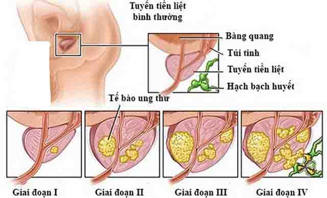 Ung thư tuyến tiền liệt - Dấu hiệu nghi ngờ mắc ung thư tuyến tiền liệt, cách nhận biết