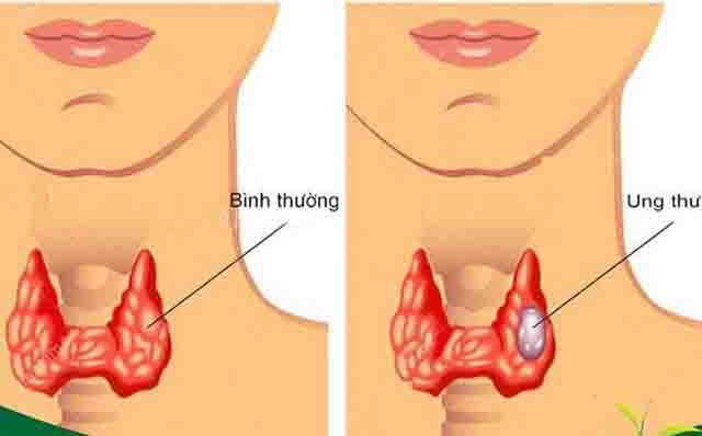 Tuyến giáp - Tìm hiểu những bệnh lý liên quan đến tuyến giáp
