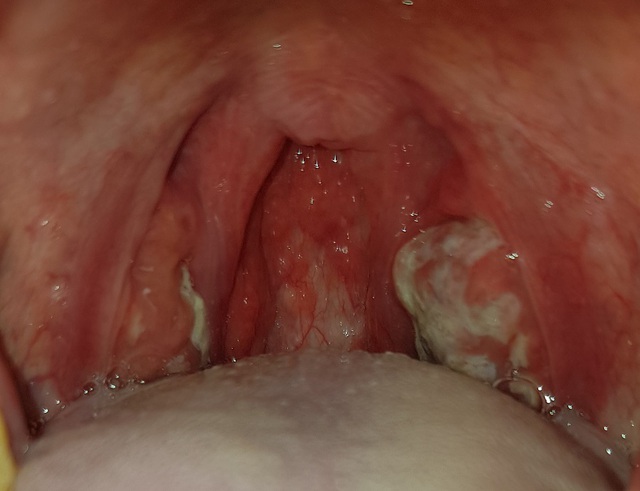 Bệnh bạch hầu - Những điều cần biết về bệnh bạch hầu
