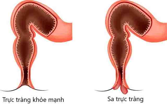 Sa trực tràng - Thông tin cần biết về bệnh sa trực tràng, nguyên nhân, triệu chứng