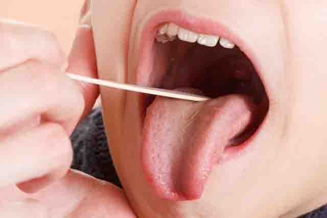 Những lưu ý khi bị viêm amidan