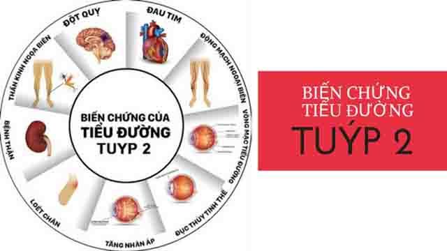 Đái tháo đường type 2 - Những yếu tố nguy cơ mắc bệnh đái tháo đường type 2