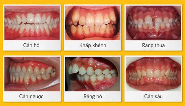 Niềng răng là gì