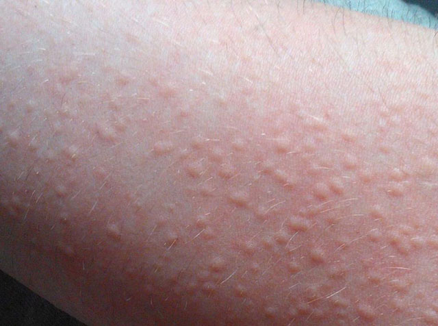 Bệnh chàm và cách điều trị hiệu quả