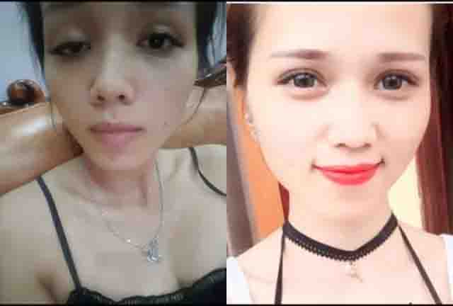 Phẫu thuật chỉnh sửa mí mắt