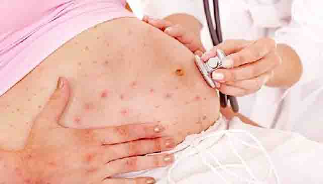Rubella - Phụ nữ mang thai phương pháp phòng bệnh Rubella, dấu hiệu nhận biết