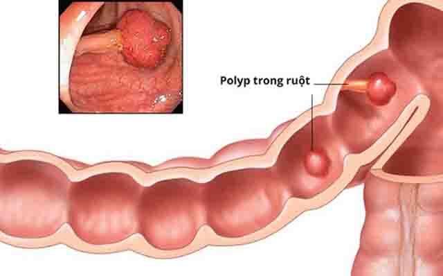 Polyp đại tràng - Thông tin về polyp đại tràng, triệu chứng, nguyên nhân