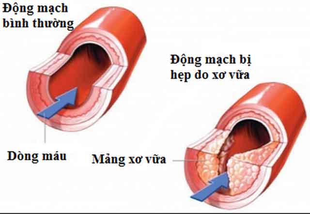 Phòng ngừa xơ vữa mạch máu