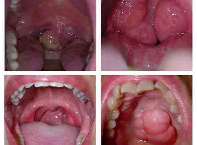 Ung thư khoang miệng - Tìm hiểu cách phòng tránh ung thư khoang miệng