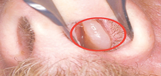 Polyp mũi – Tìm hiểu sự hình thành Polyp mũi, phòng tránh