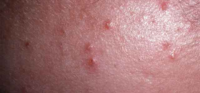 Quan hệ xong bị nổi mẩn đỏ