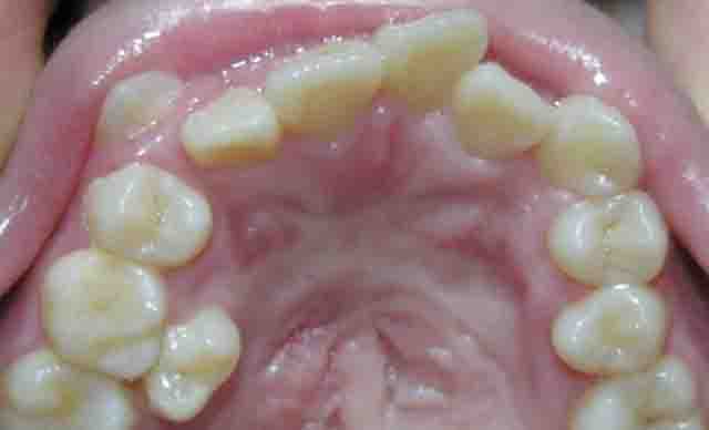 Răng mọc sai vị trí - Nguyên nhân răng mọc sai vị trí?