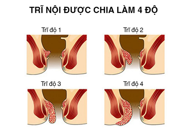 Review chữa bệnh trĩ