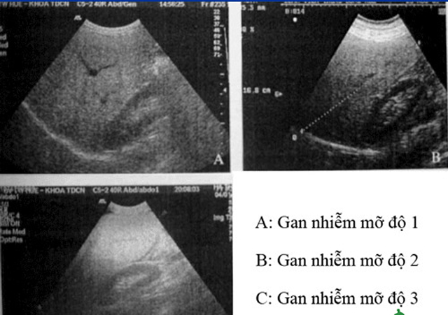 Siêu âm gan nhiễm mỡ