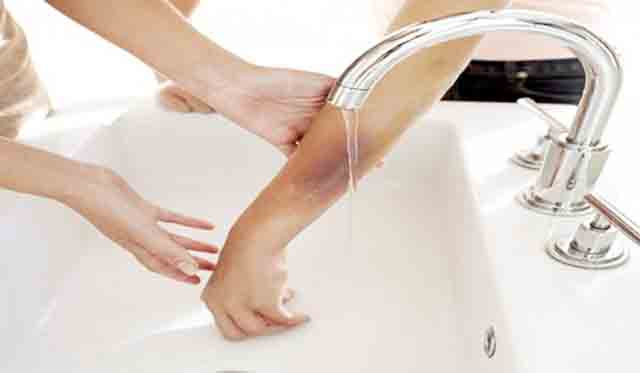Cách tiến hành sơ cứu bỏng
