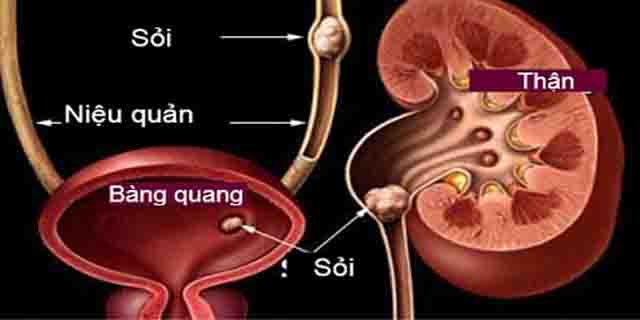Bệnh sỏi bàng quang và cách điều trị hiệu quả