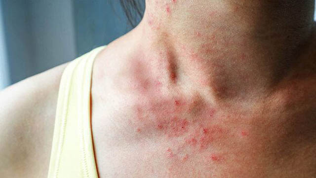 Sốt nổi mề đay ở người lớn