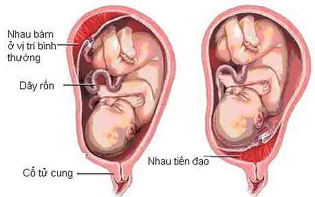 Rau tiền đạo - Sự nguy hiểm của rau tiền đạo, biểu hiện