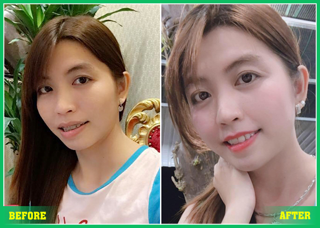 Tác dụng của niềng răng