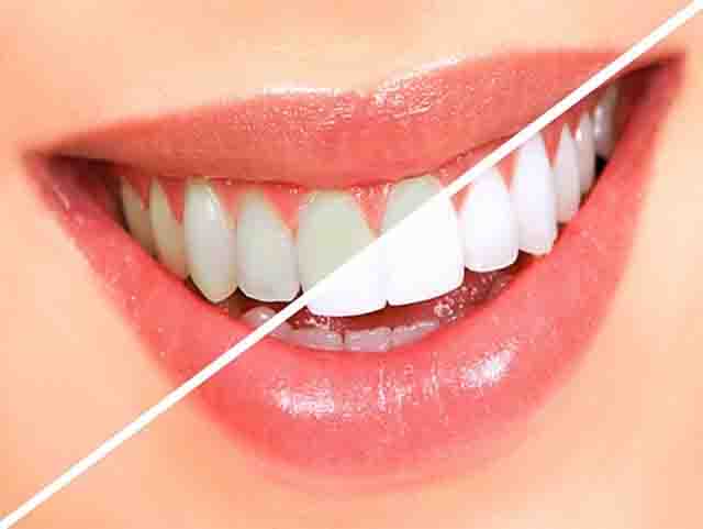 Tẩy trắng răng và cách điều trị hiệu quả