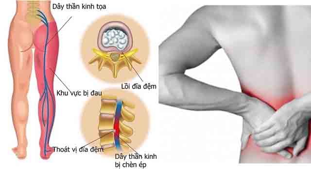 Mổ thoát vị đĩa đệm có ảnh hưởng gì không
