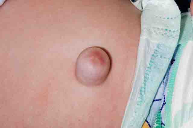 Thoát vị rốn - Tìm hiểu về bệnh thoát vị rốn ở trẻ em