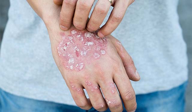 Thuốc chữa bệnh vảy nến mới nhất của thế giới